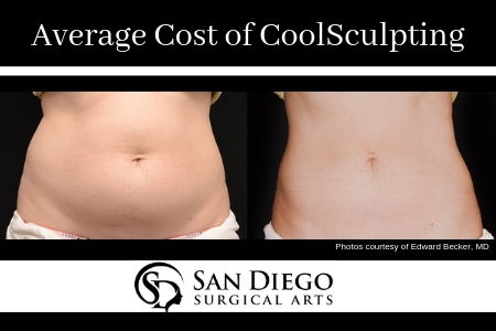 What To Expect Before, During & After A CoolSculpting® Treatment